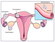 Dış Gebelik Nedir? Dış Gebelik Nedir?