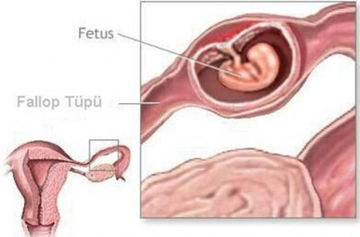 Dış Gebelik İğnesi Kullanımı ve Faydaları Nelerdir? Dış Gebelik İğnesi Kullanımı ve Faydaları Nelerdir?